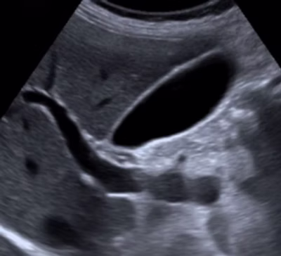 private gallbladder ultrasound