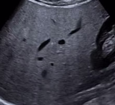 liver ultrasound